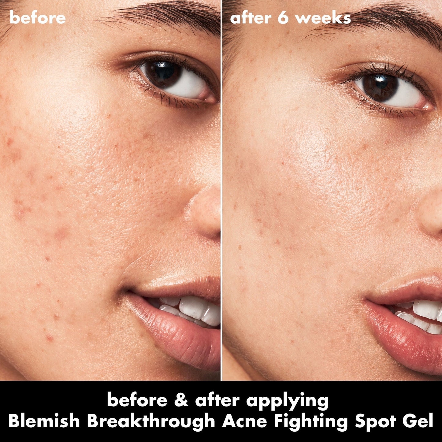 blemish-breakthrough-acne-fighting-spot-gel-d6 0326_EDU_BB_SpotGel_BA_ISABELLA.jpg