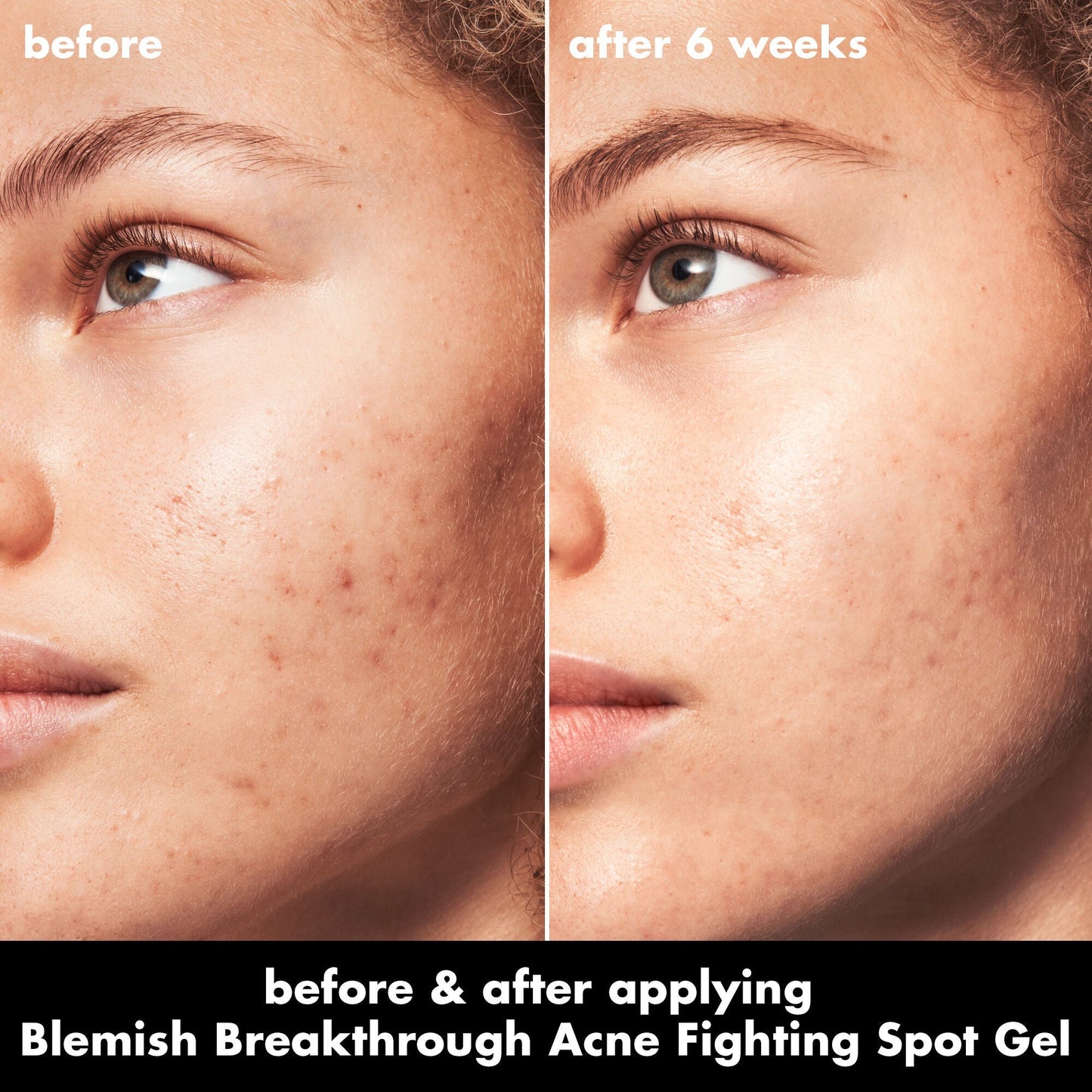 blemish-breakthrough-acne-fighting-spot-gel-d6 0326_EDU_BB_SpotGel_BA_MARLEY.jpg