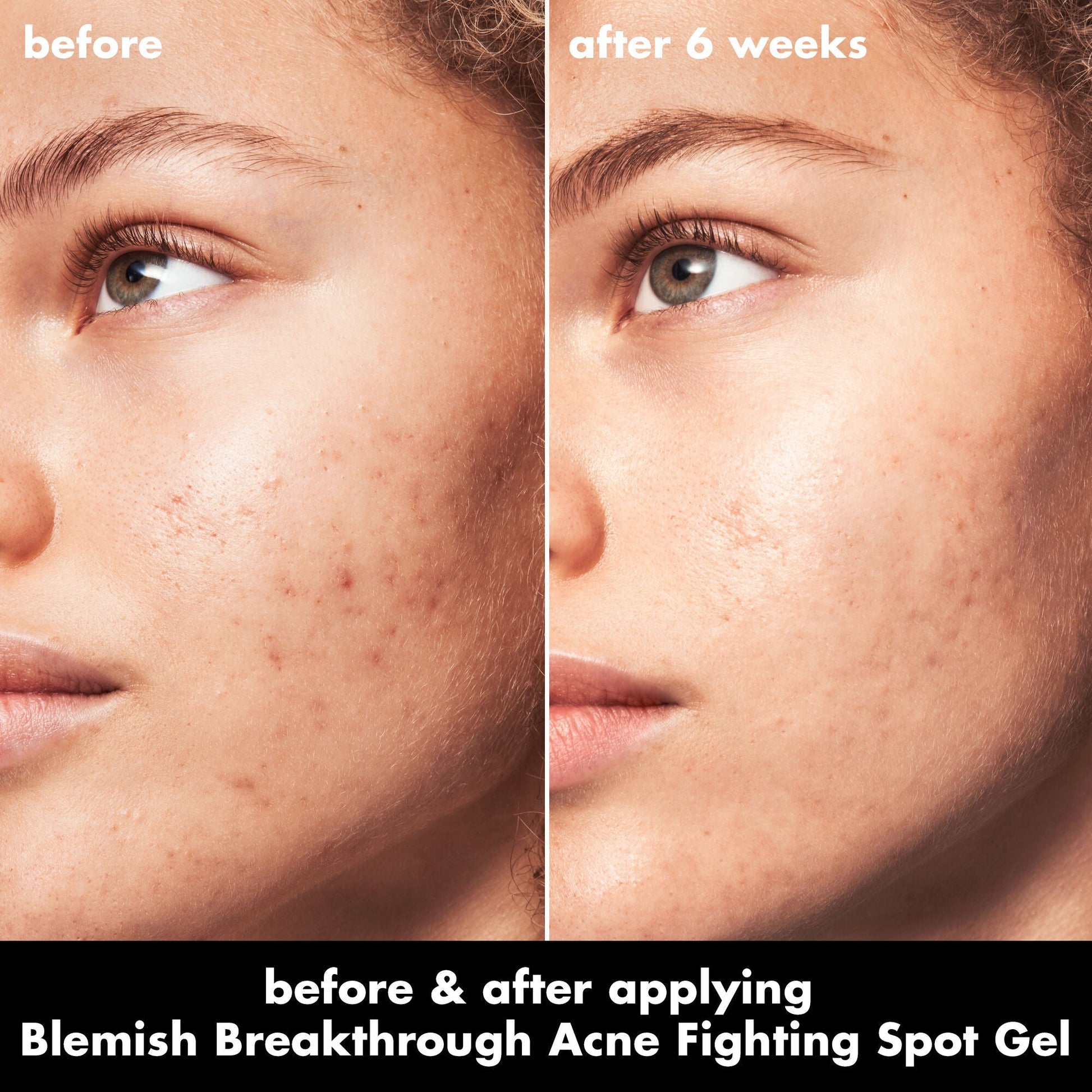 blemish-breakthrough-acne-fighting-spot-gel-d6 0326_EDU_BB_SpotGel_BA_MARLEY.jpg