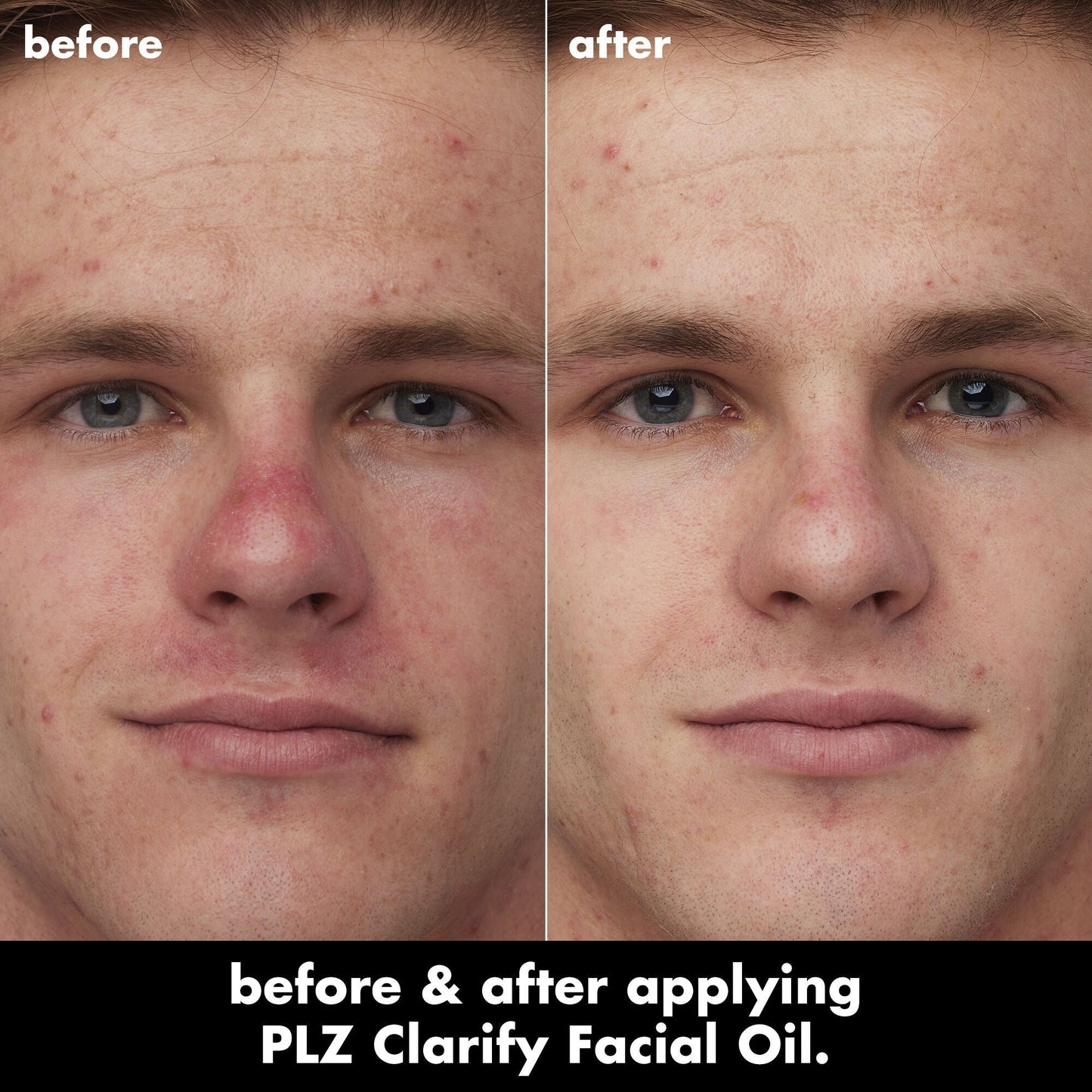 plz-clarify-facial-oil-y0 0326_EDU_PlzClarify_BA_Caleb.jpg