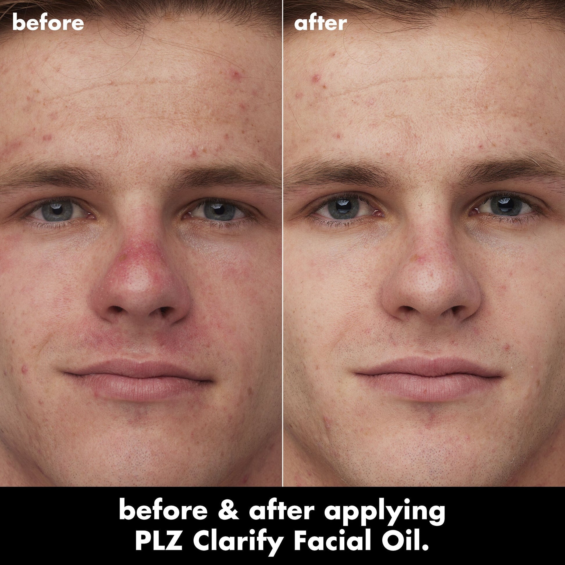 plz-clarify-facial-oil-y0 0326_EDU_PlzClarify_BA_Caleb.jpg