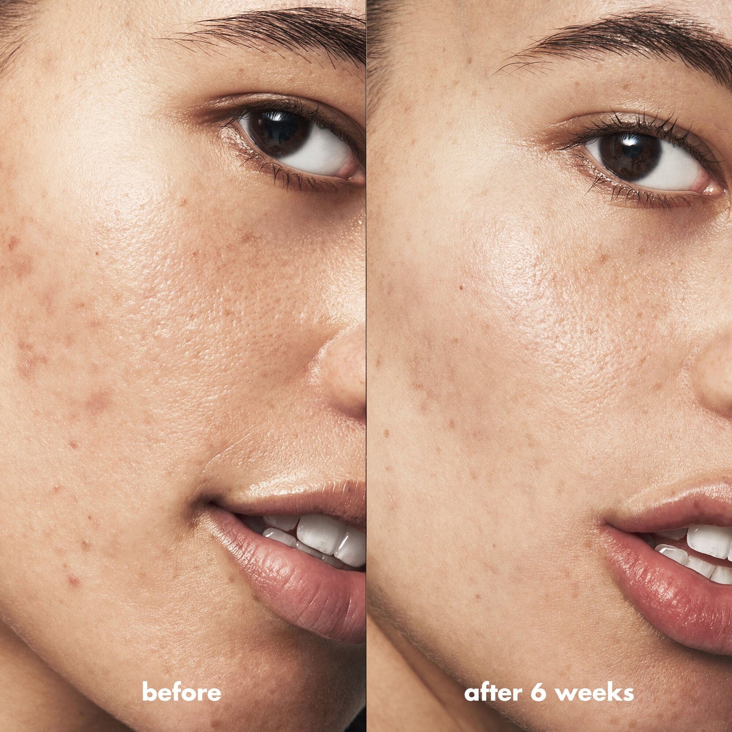 blemish-breakthrough-triple-acid-resurfacing-serum-t7 Acne_PDP_Isabella_Before_After_b8fe0505-ae5c-4baa-9a8e-fd889e4c3414.jpg
