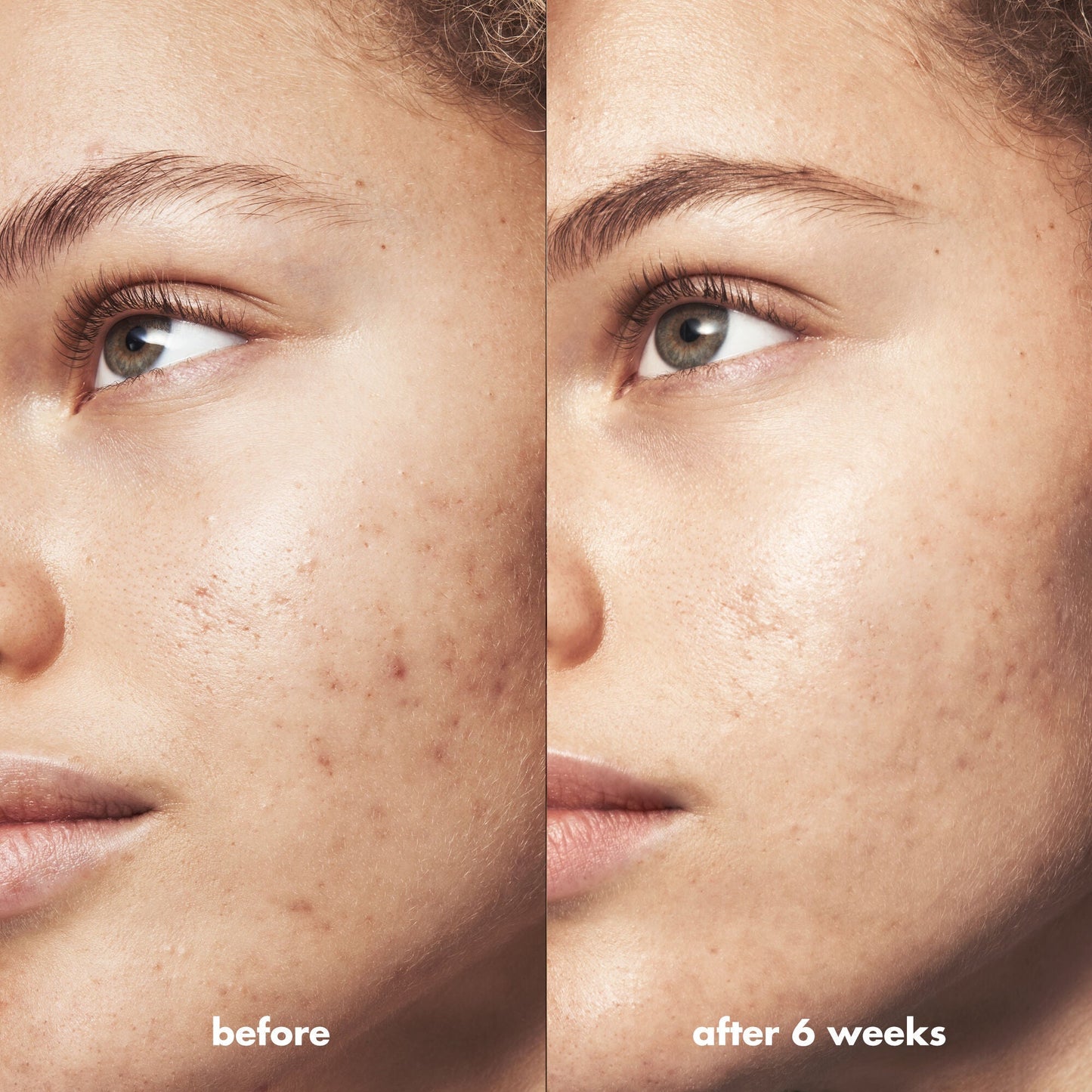 blemish-breakthrough-triple-acid-resurfacing-serum-t7 Acne_PDP_Marley_Before_After_1a95cac5-0af6-43b6-a936-d0bacbdec0bf.jpg